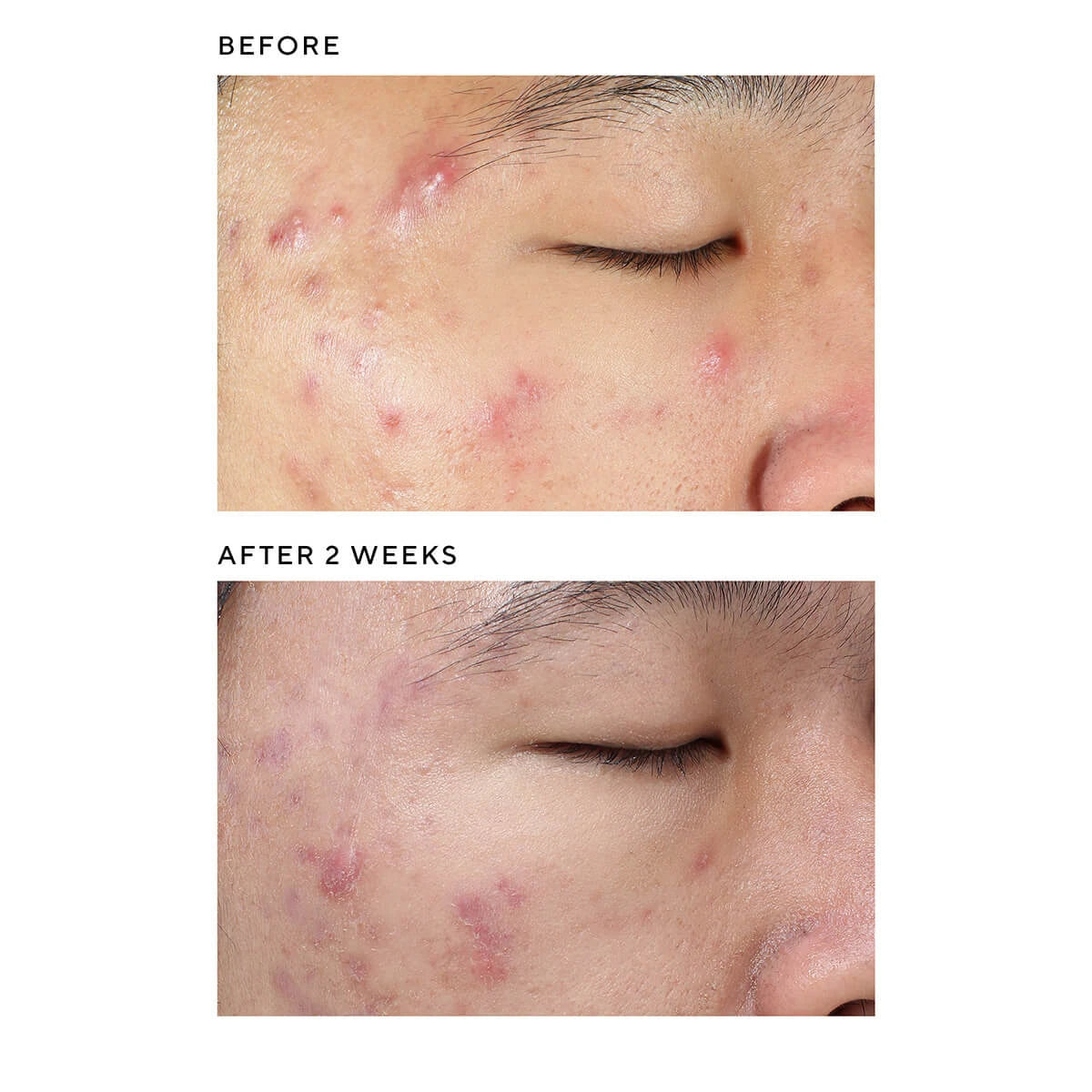 Deep Relief Blemish Treatment, Blemish Control, 30 ml.